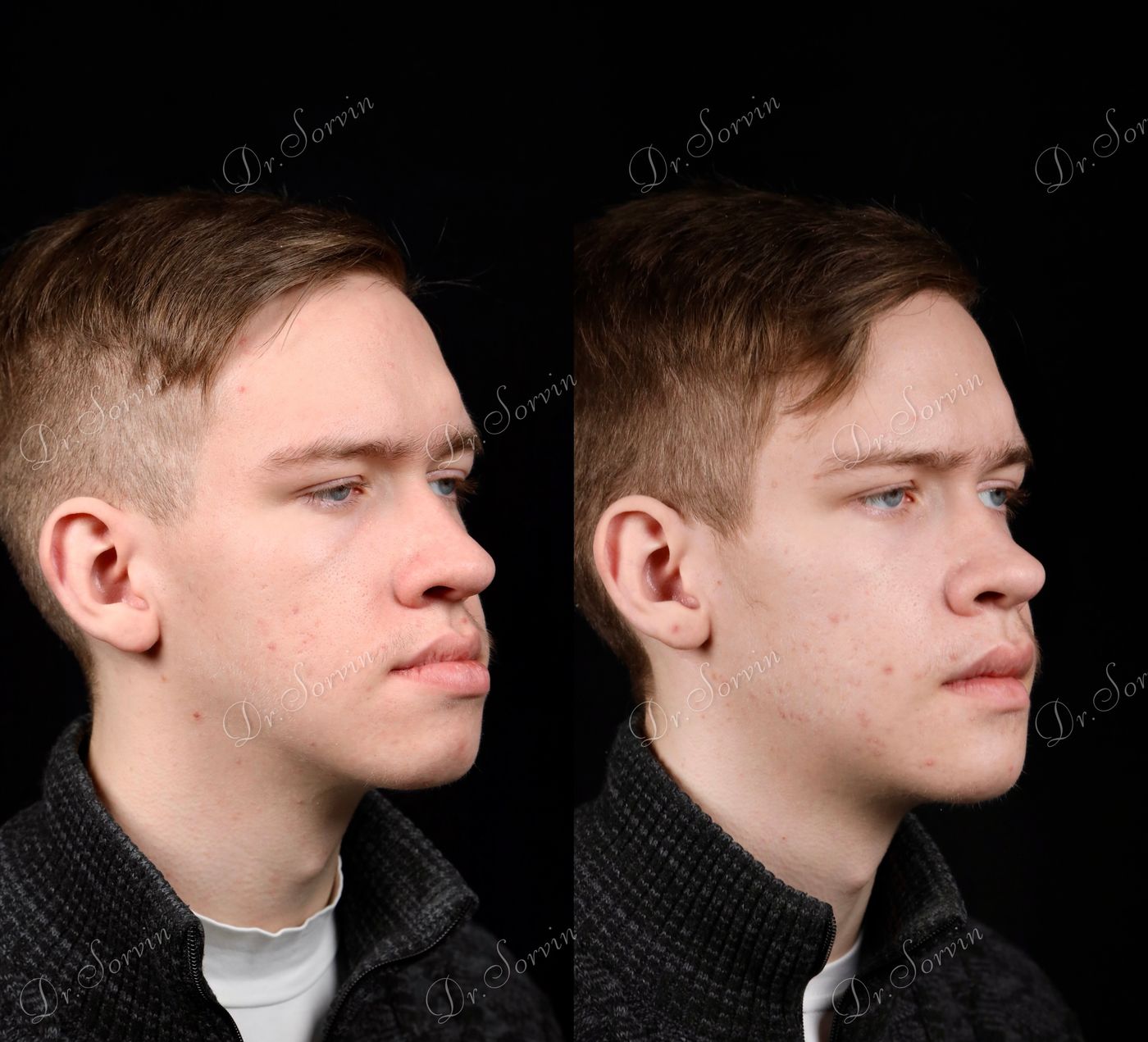 Class III skeletal malocclusion — 3 — before and after, photo 4