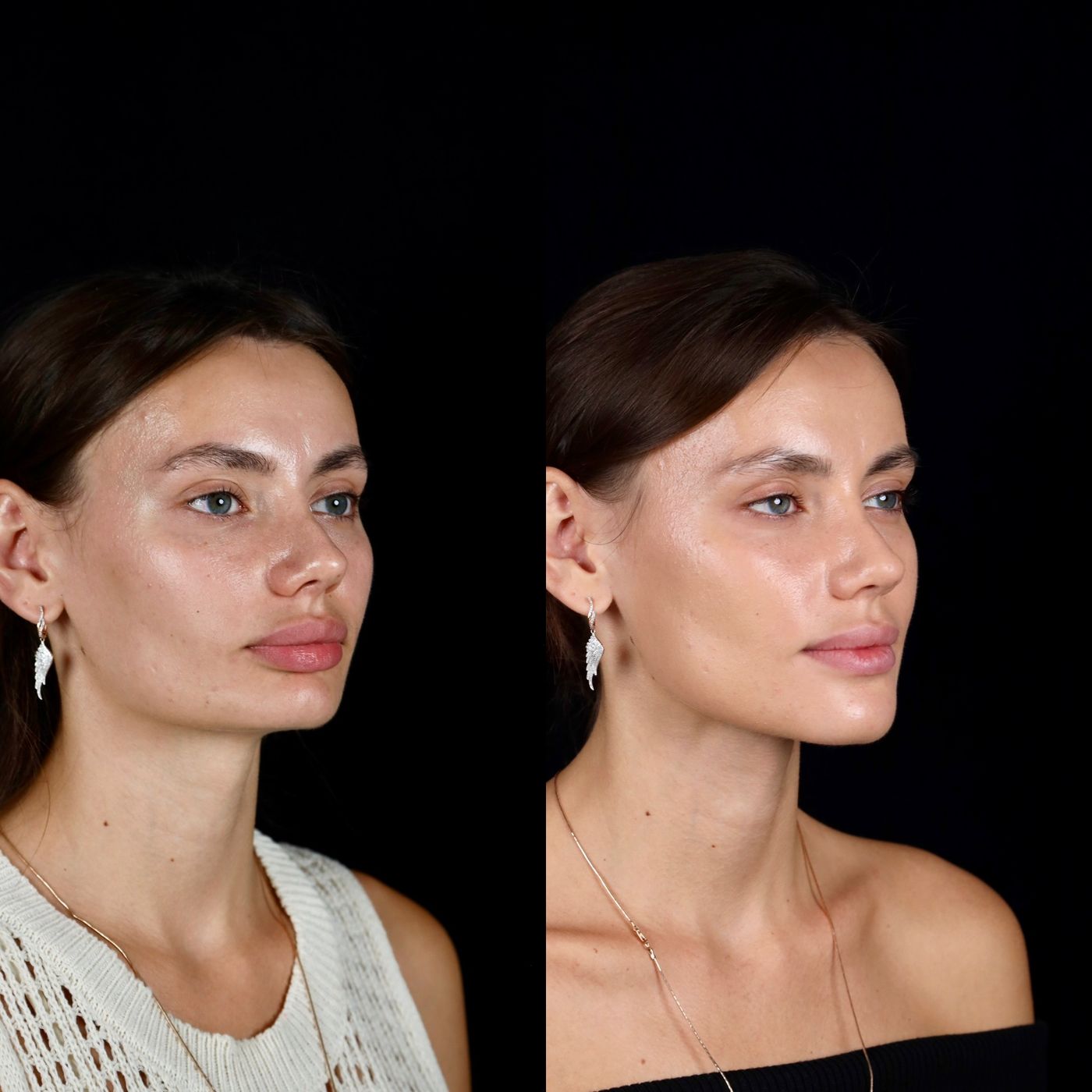 Increasing facial height — before and after, photo 1