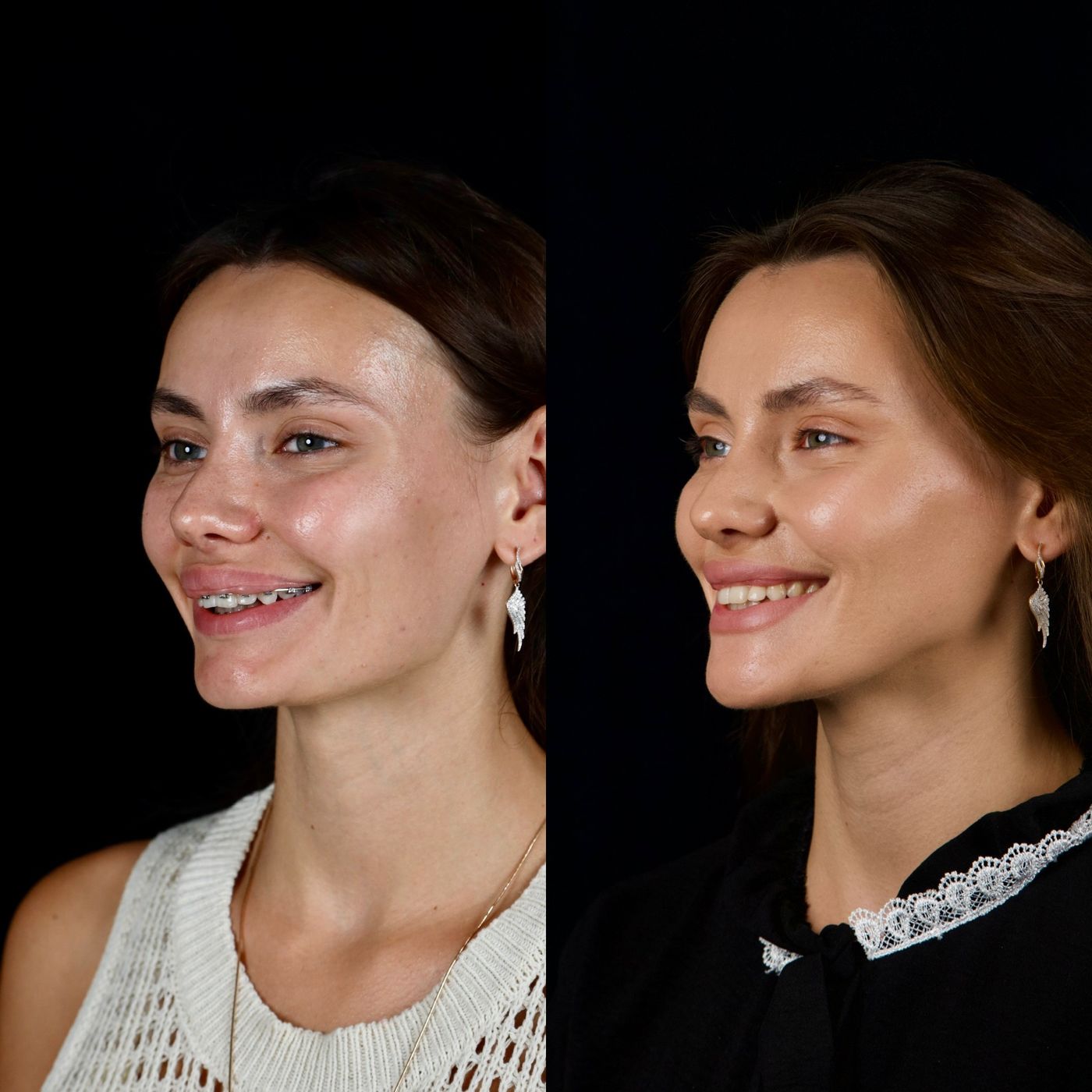 Increasing facial height — before and after, photo 2