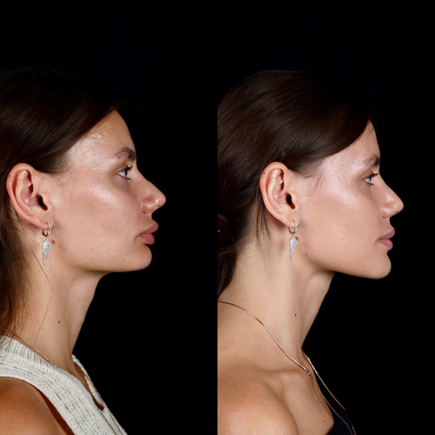 Increasing facial height — before and after, photo 3