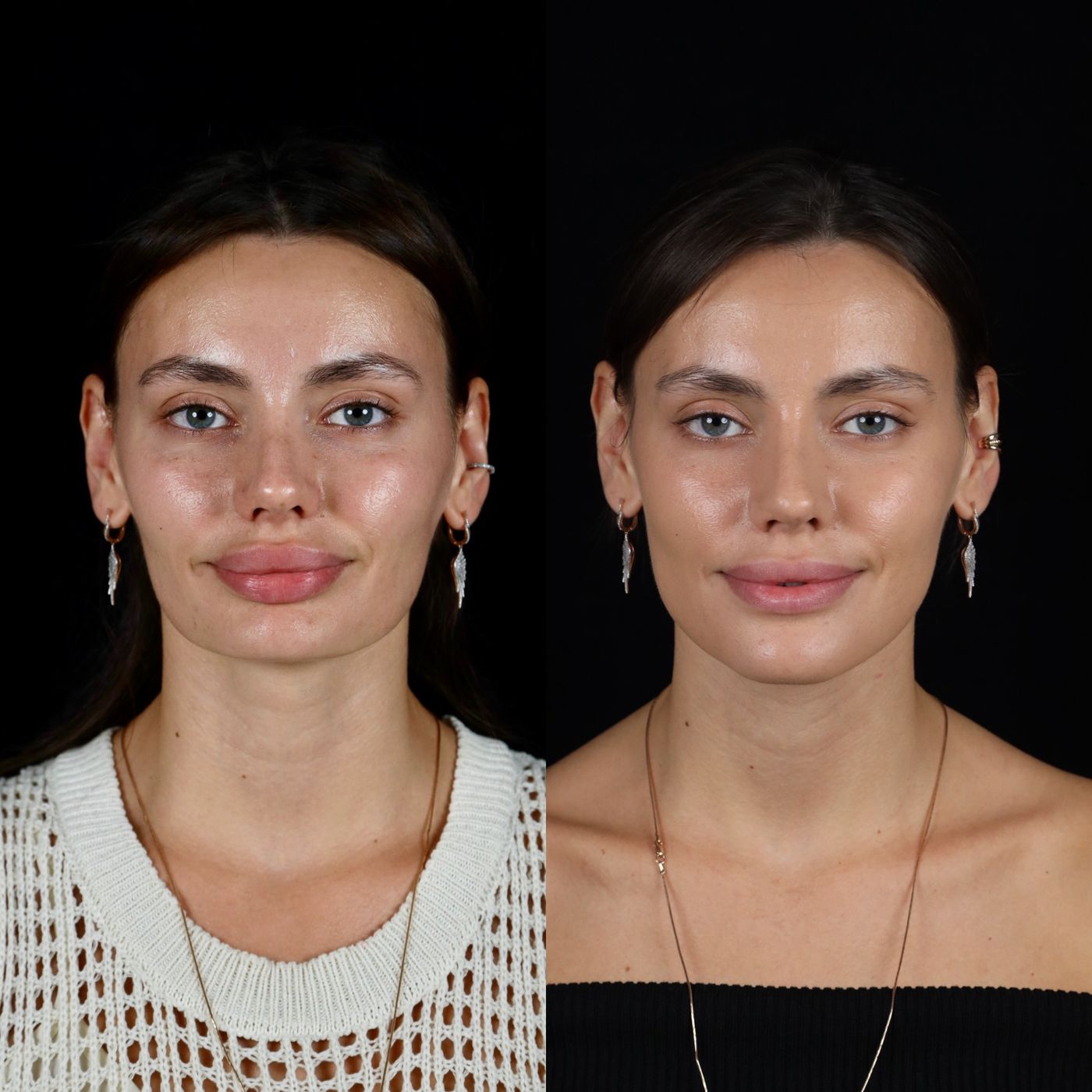 Increasing facial height — before and after, photo 4