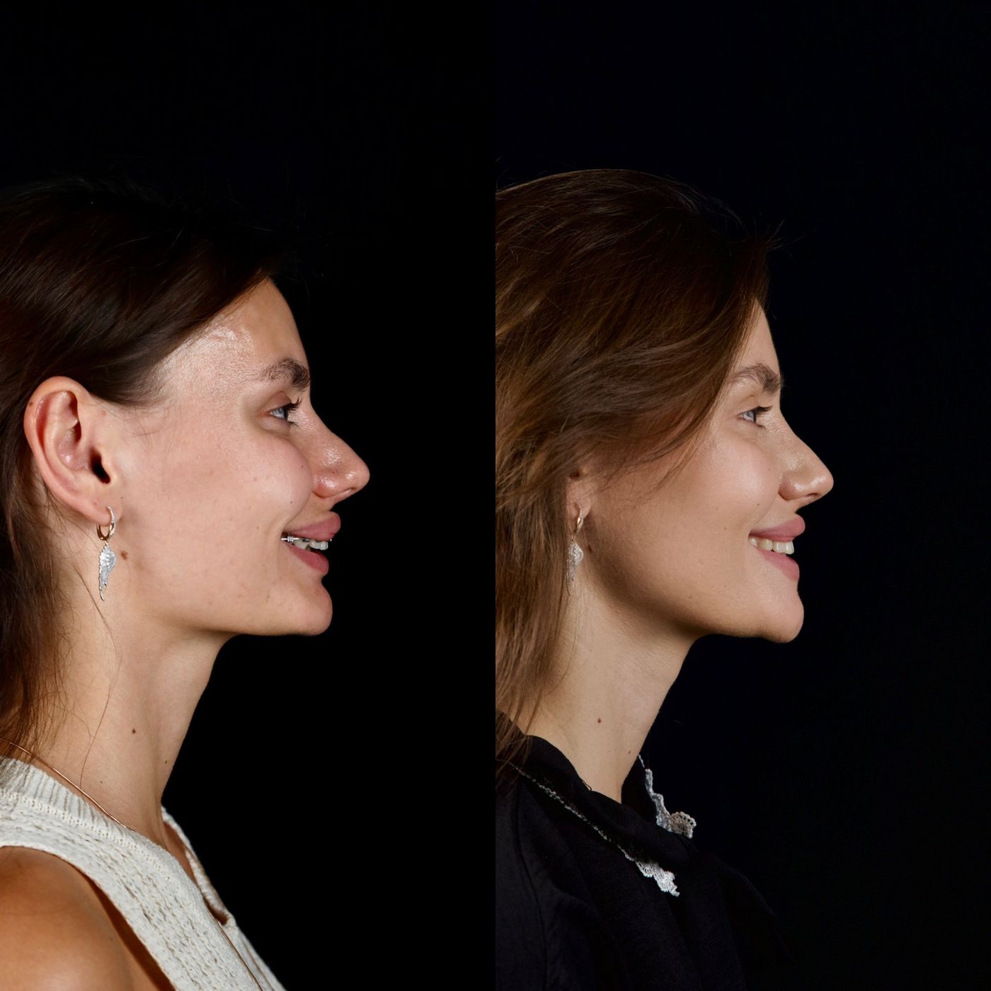 Increasing facial height — before and after, photo 5