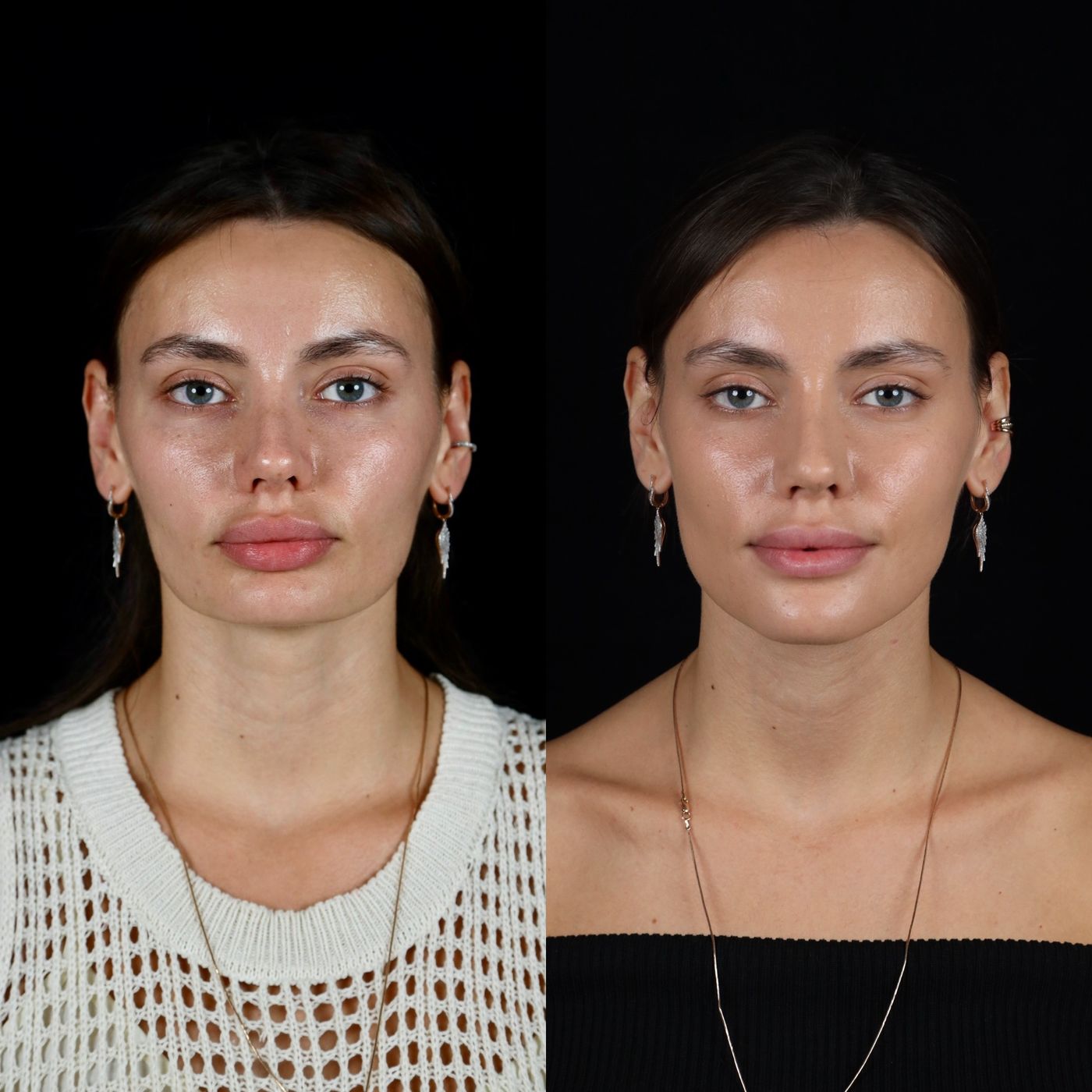 Increasing facial height — before and after, photo 6