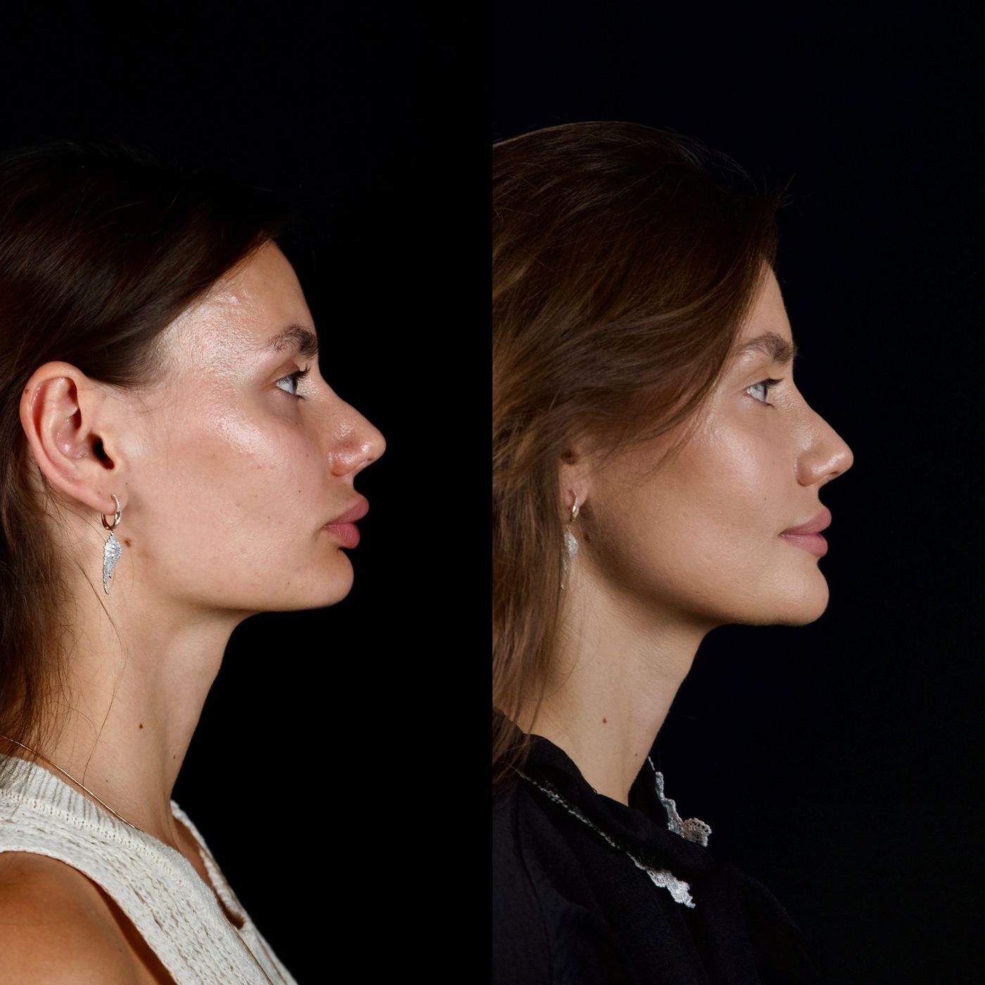 Increasing facial height — before and after, photo 7