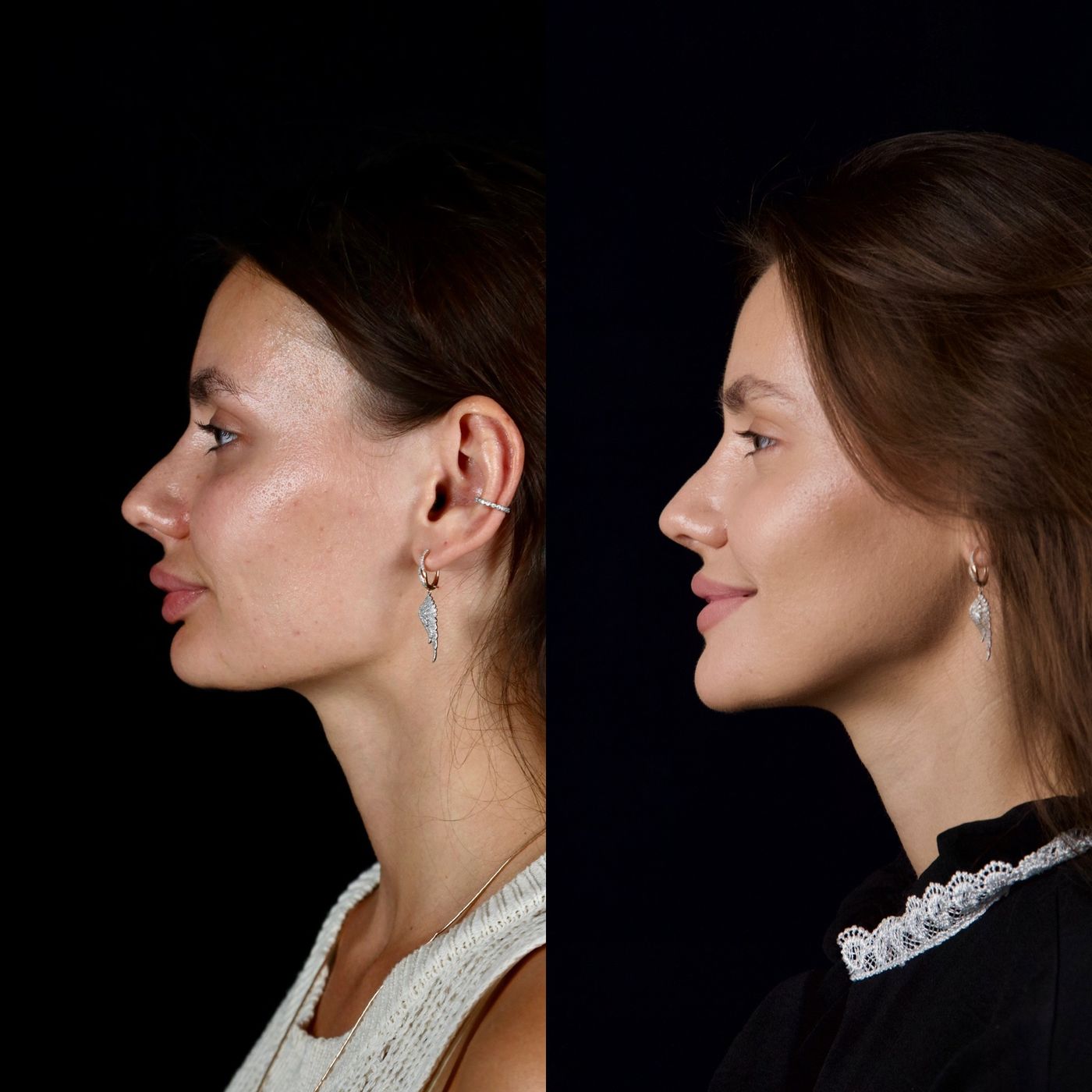 Increasing facial height — before and after, photo 8