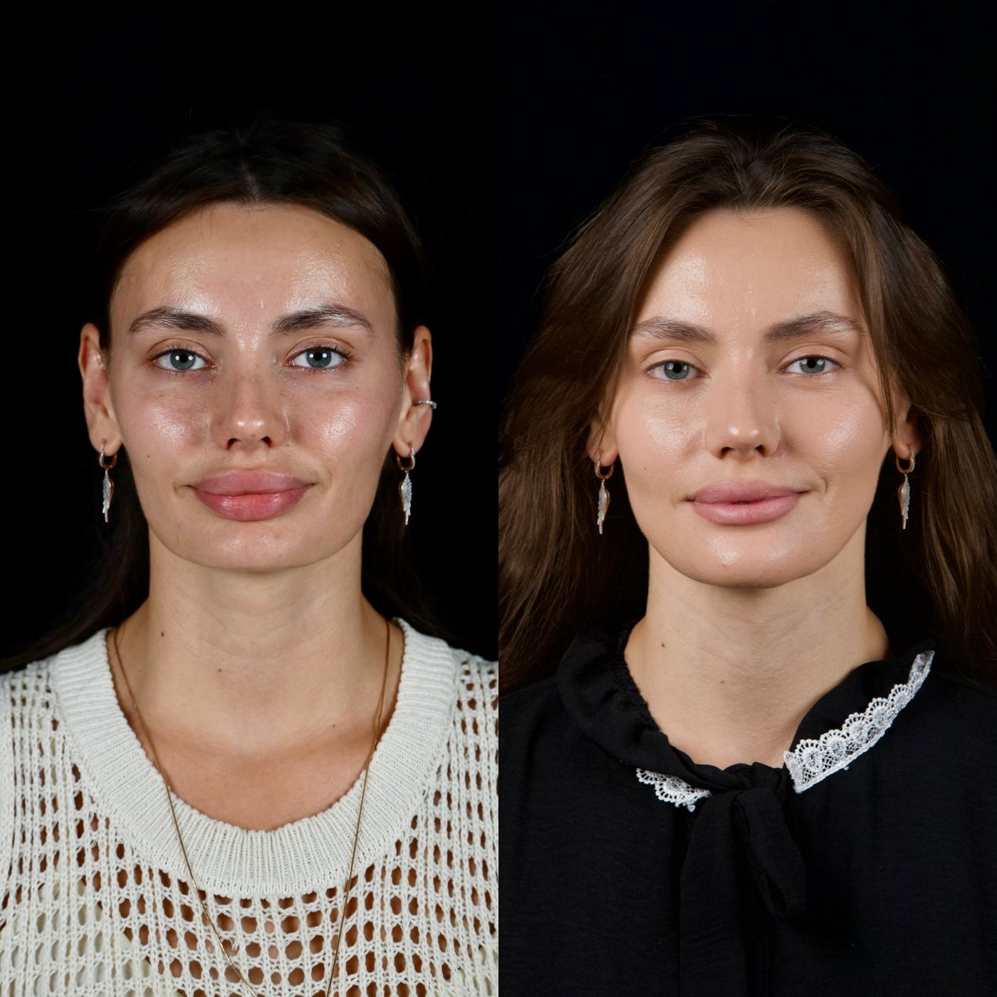 Increasing facial height — before and after, photo 9