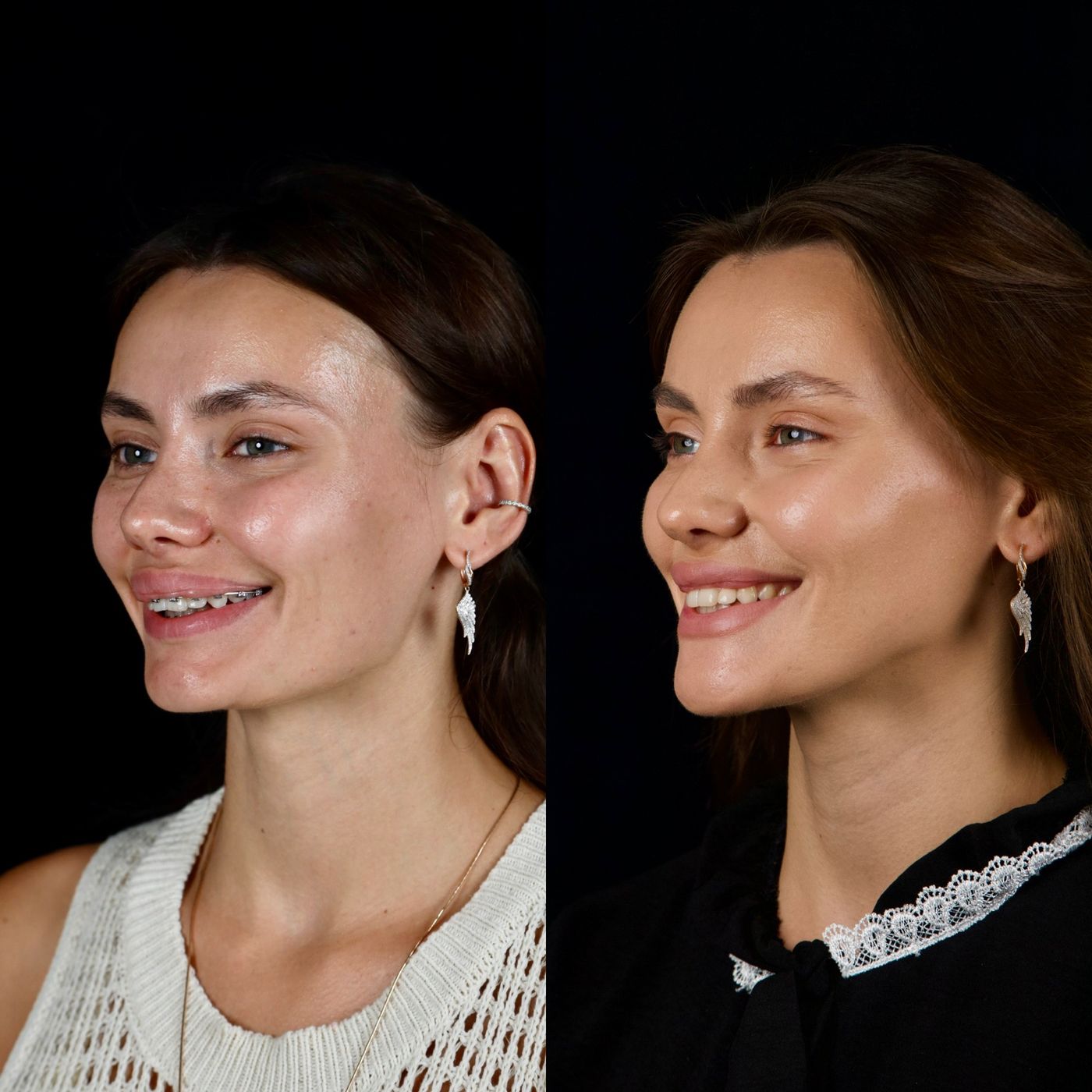Increasing facial height — before and after, photo 10
