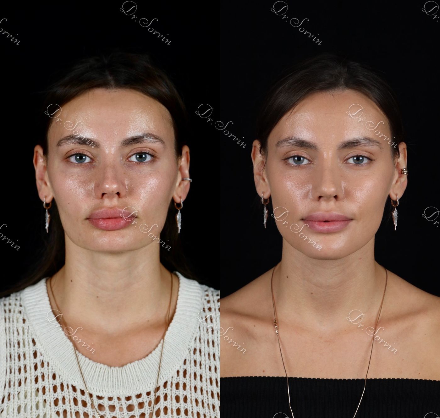 Increasing facial height — before and after, photo 11