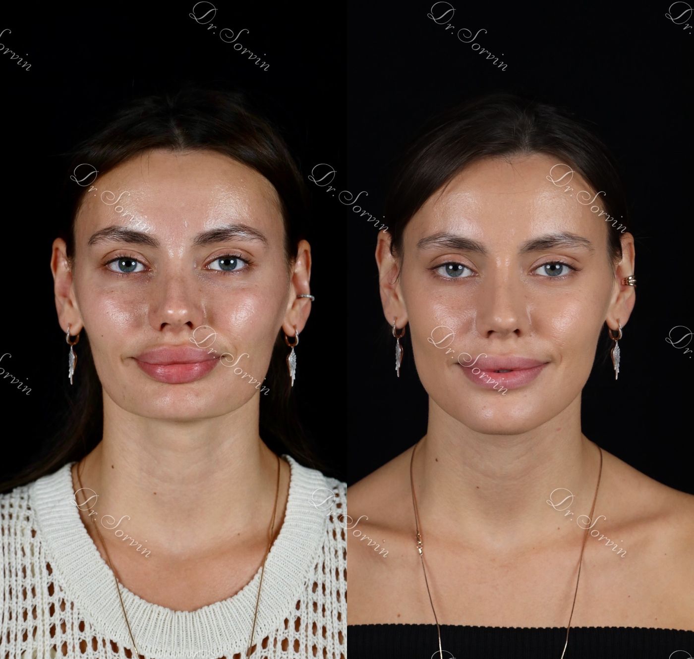 Increasing facial height — before and after, photo 12