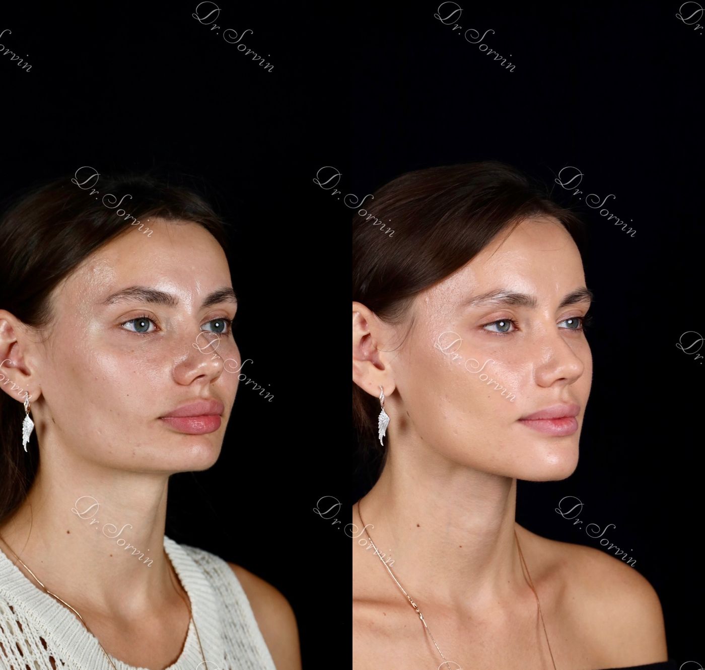 Increasing facial height — before and after, photo 14