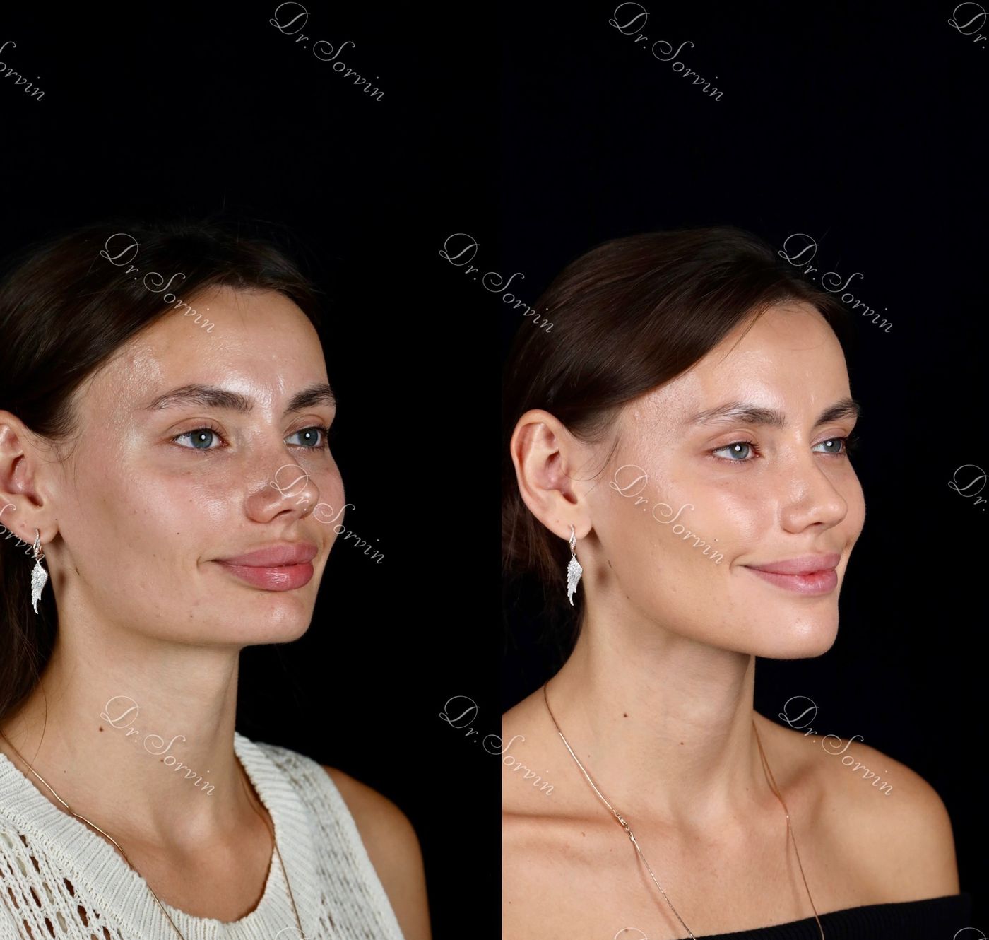 Increasing facial height — before and after, photo 15