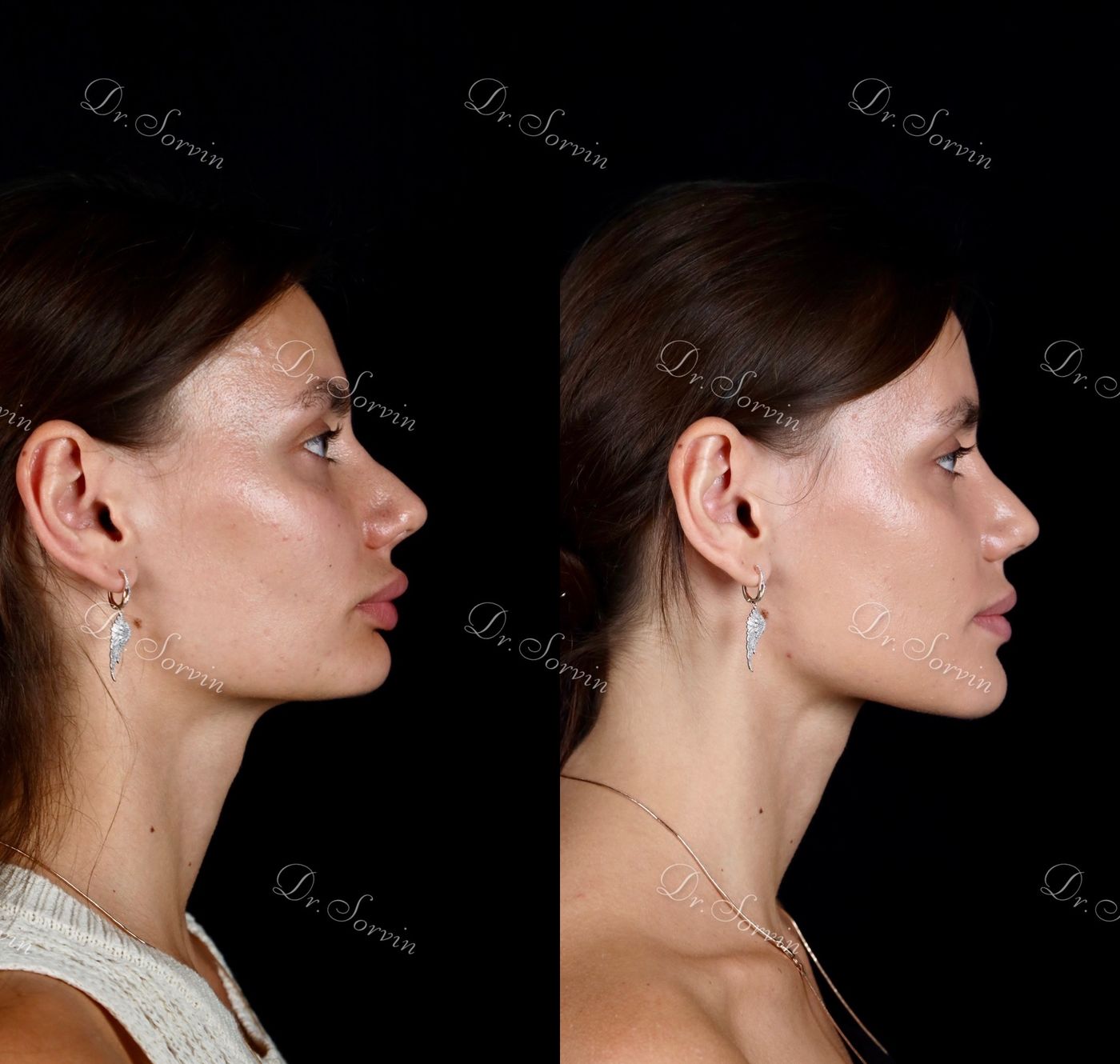 Increasing facial height — before and after, photo 16