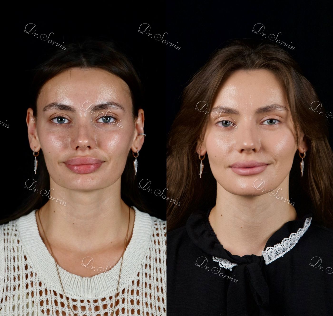 Increasing facial height — before and after, photo 17