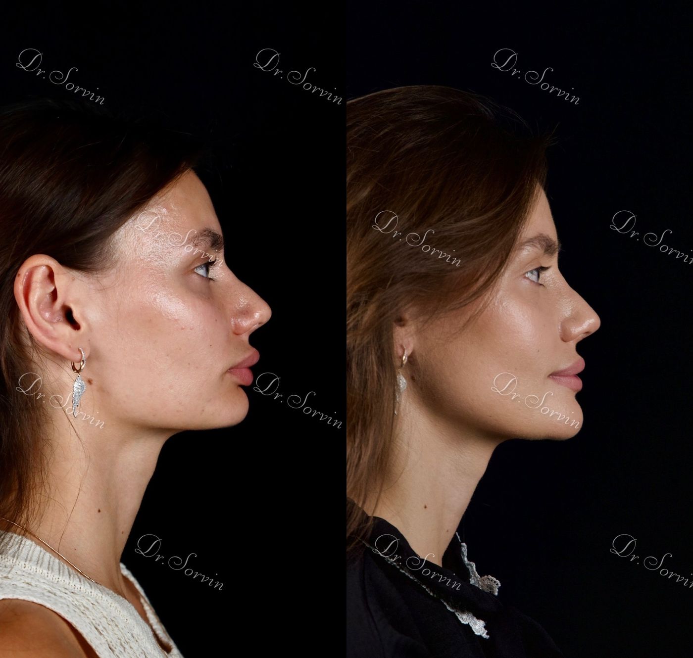 Increasing facial height — before and after, photo 18