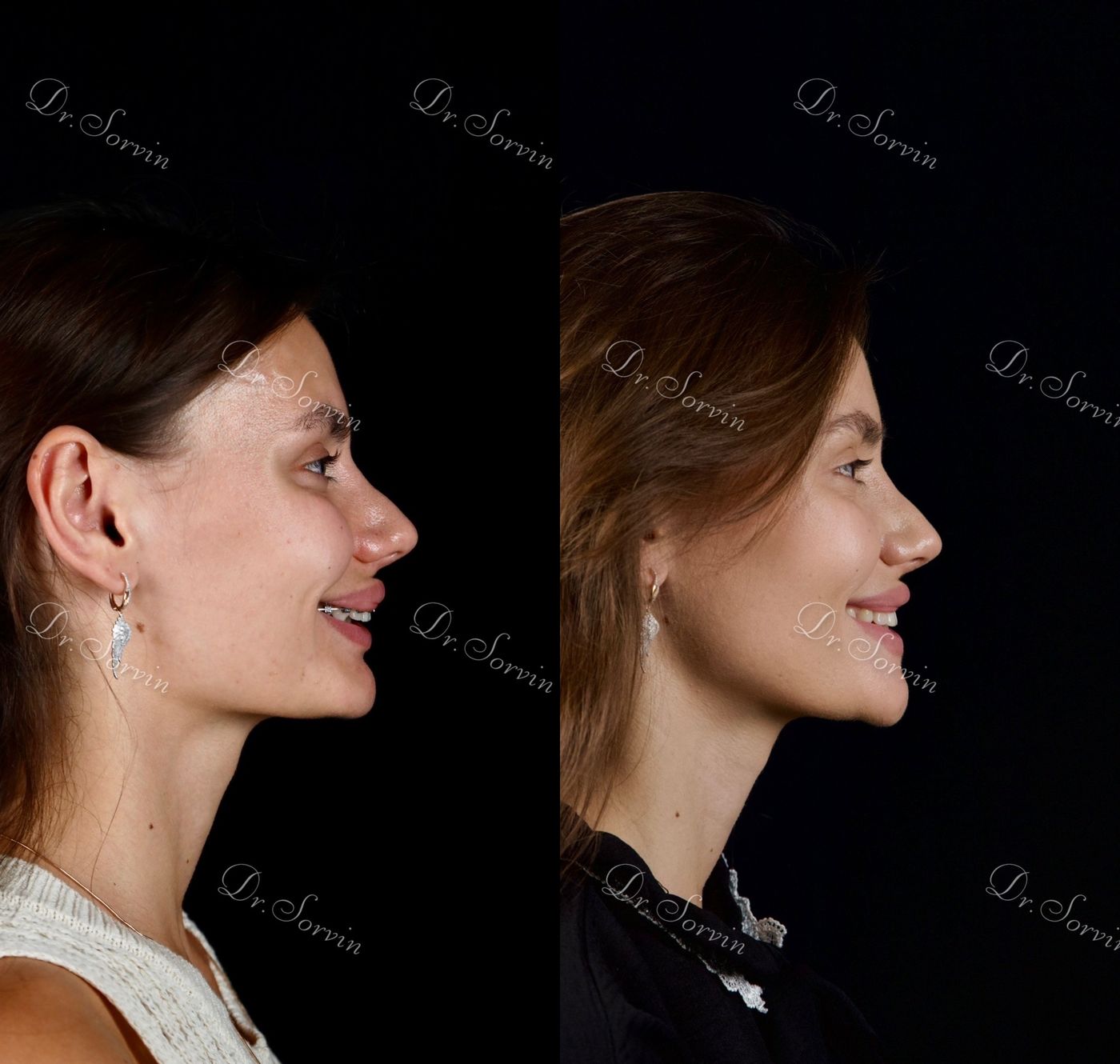 Increasing facial height — before and after, photo 19