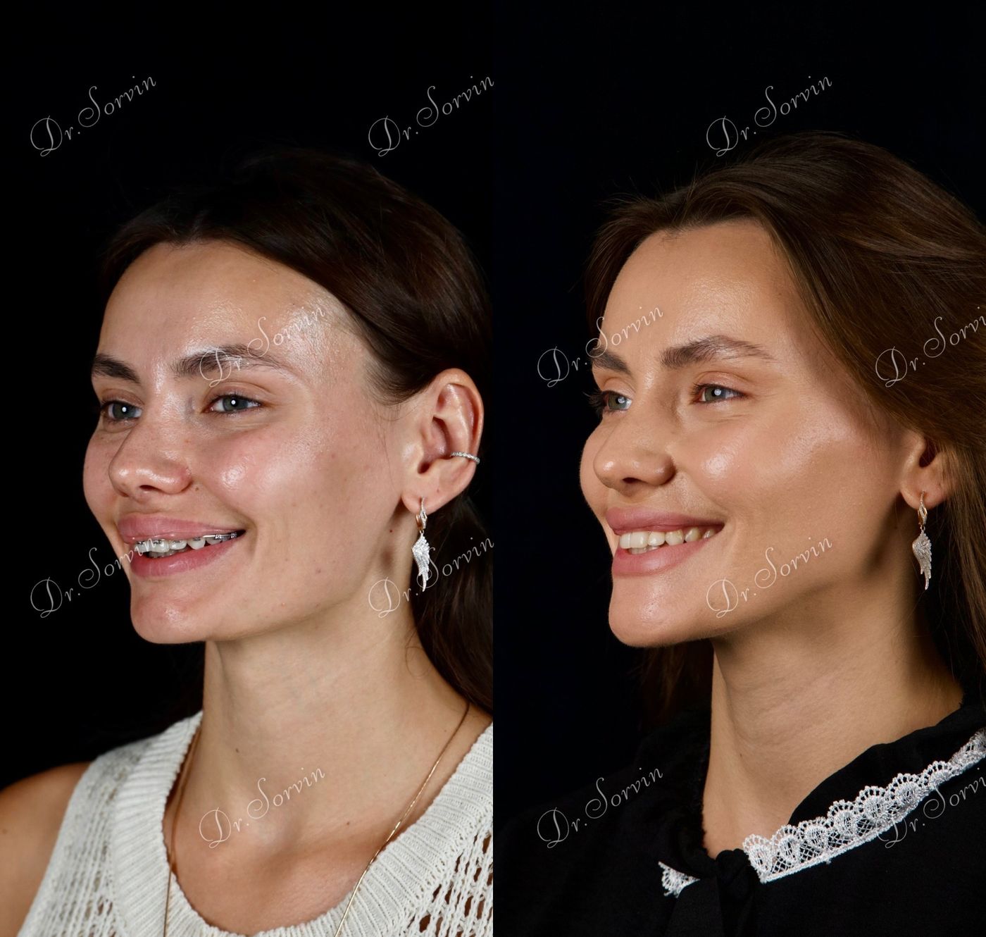 Increasing facial height — before and after, photo 20