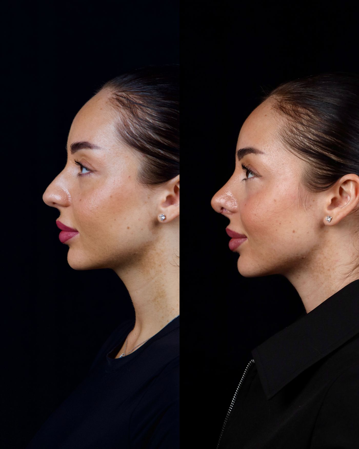 Primary rhinoplasty — before and after, photo 1