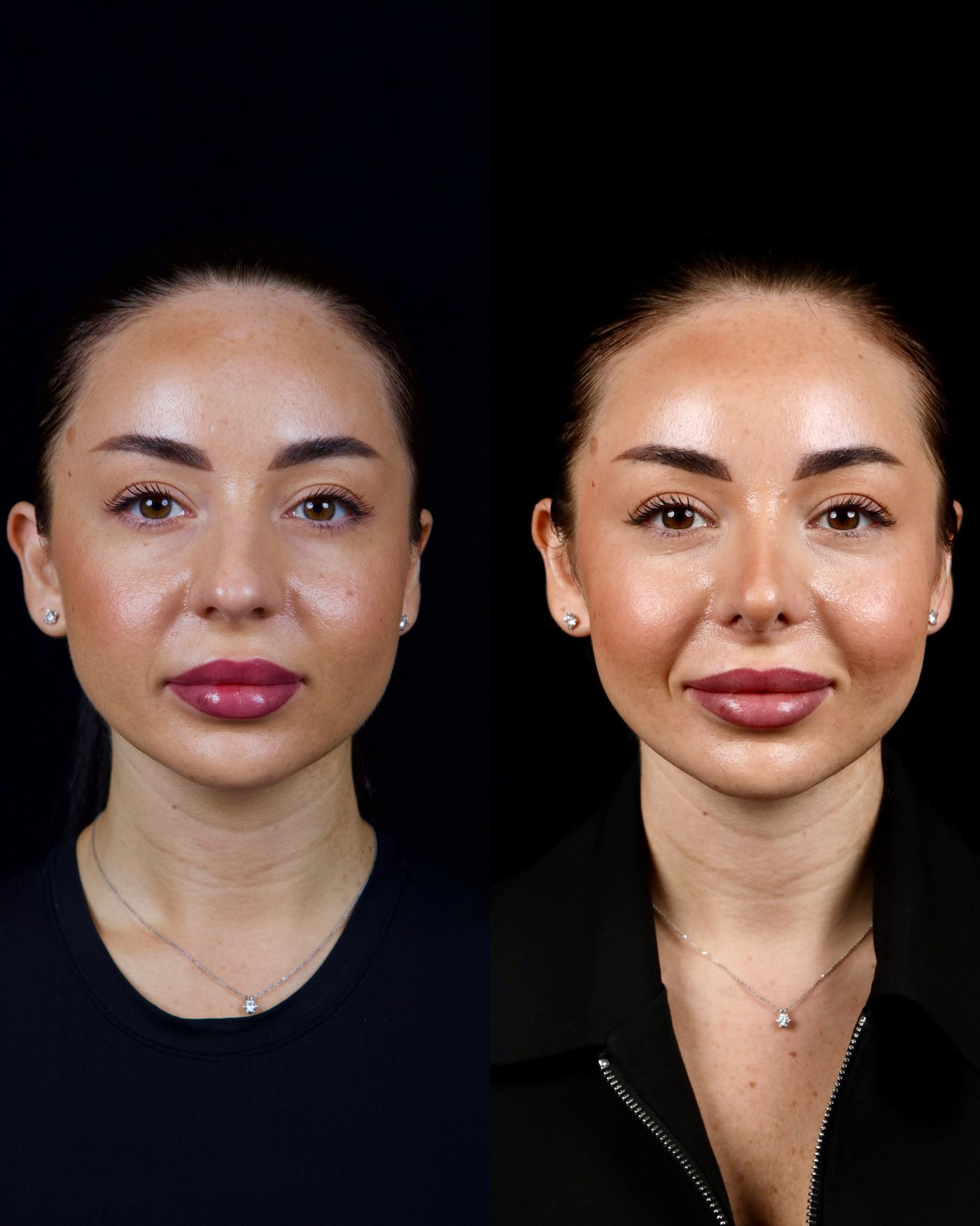 Primary rhinoplasty — before and after, photo 2