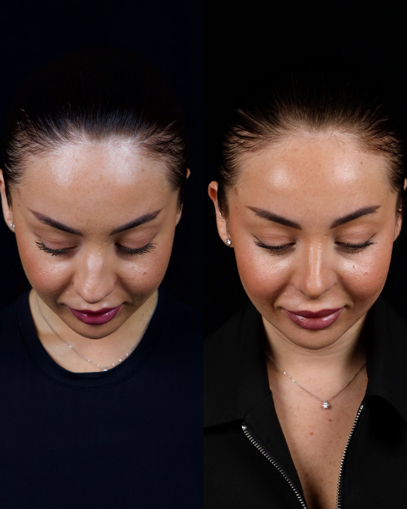 Primary rhinoplasty — before and after, photo 3