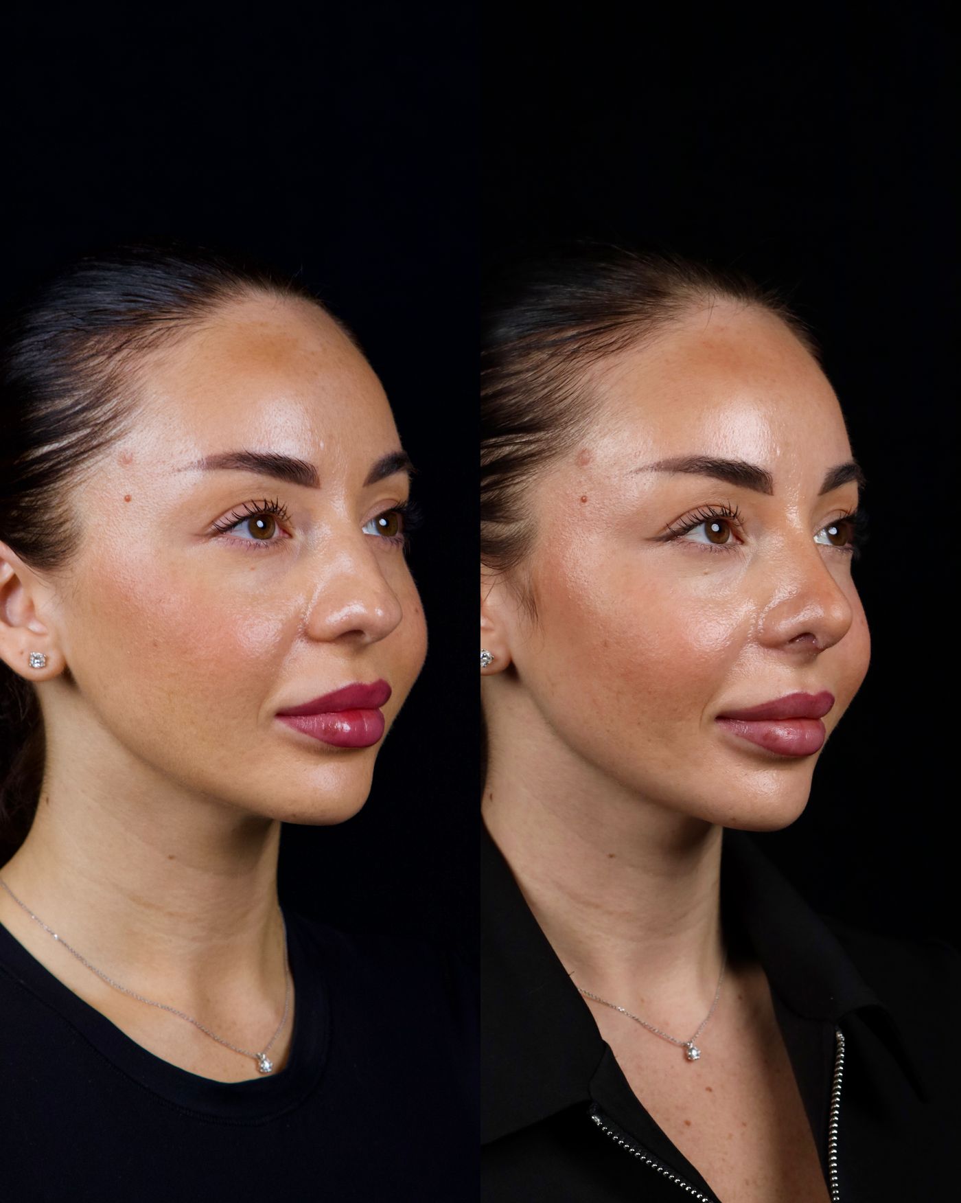Primary rhinoplasty — before and after, photo 4