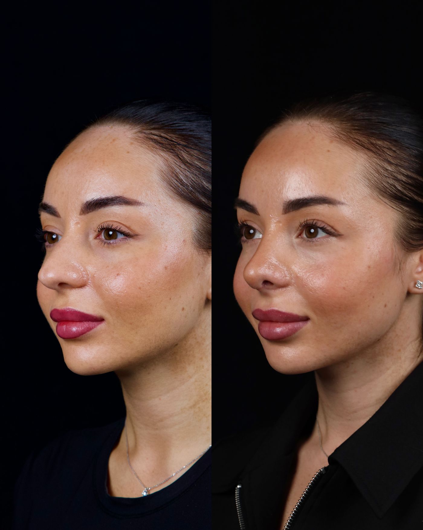 Primary rhinoplasty — before and after, photo 5