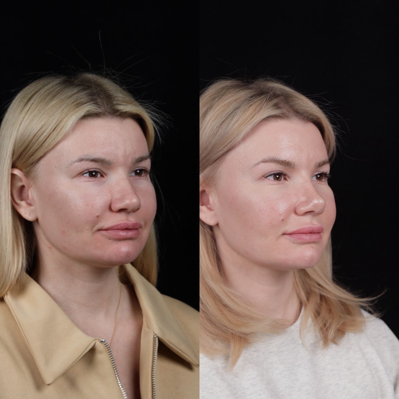 Первичная ринопластика — 2 — до и после, кадр 4
