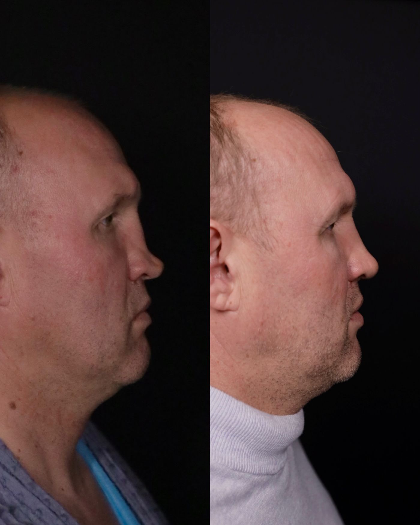 Revision rhinoplasty — before and after, photo 1