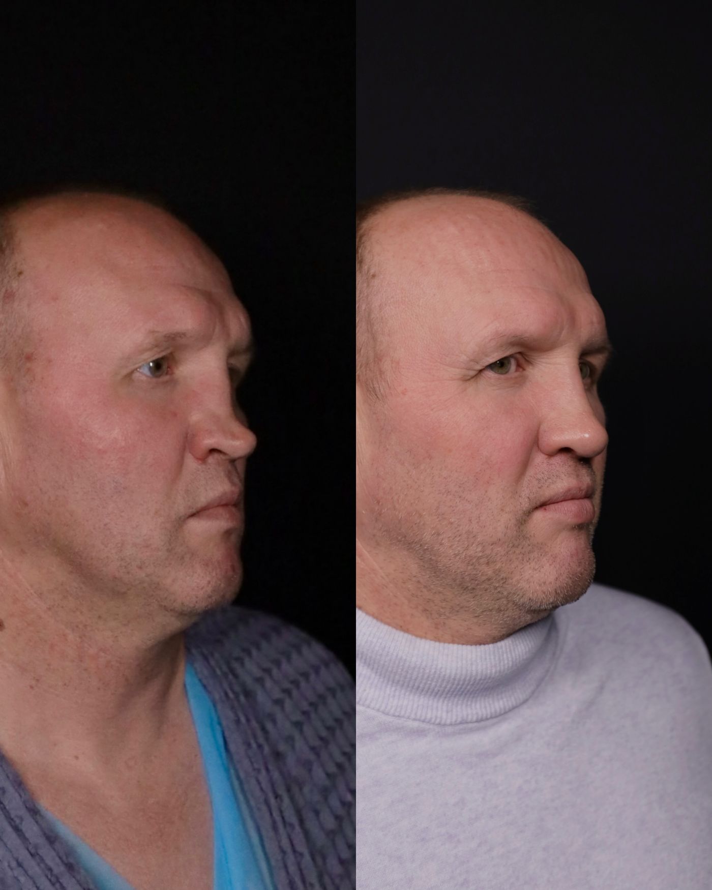 Revision rhinoplasty — before and after, photo 2