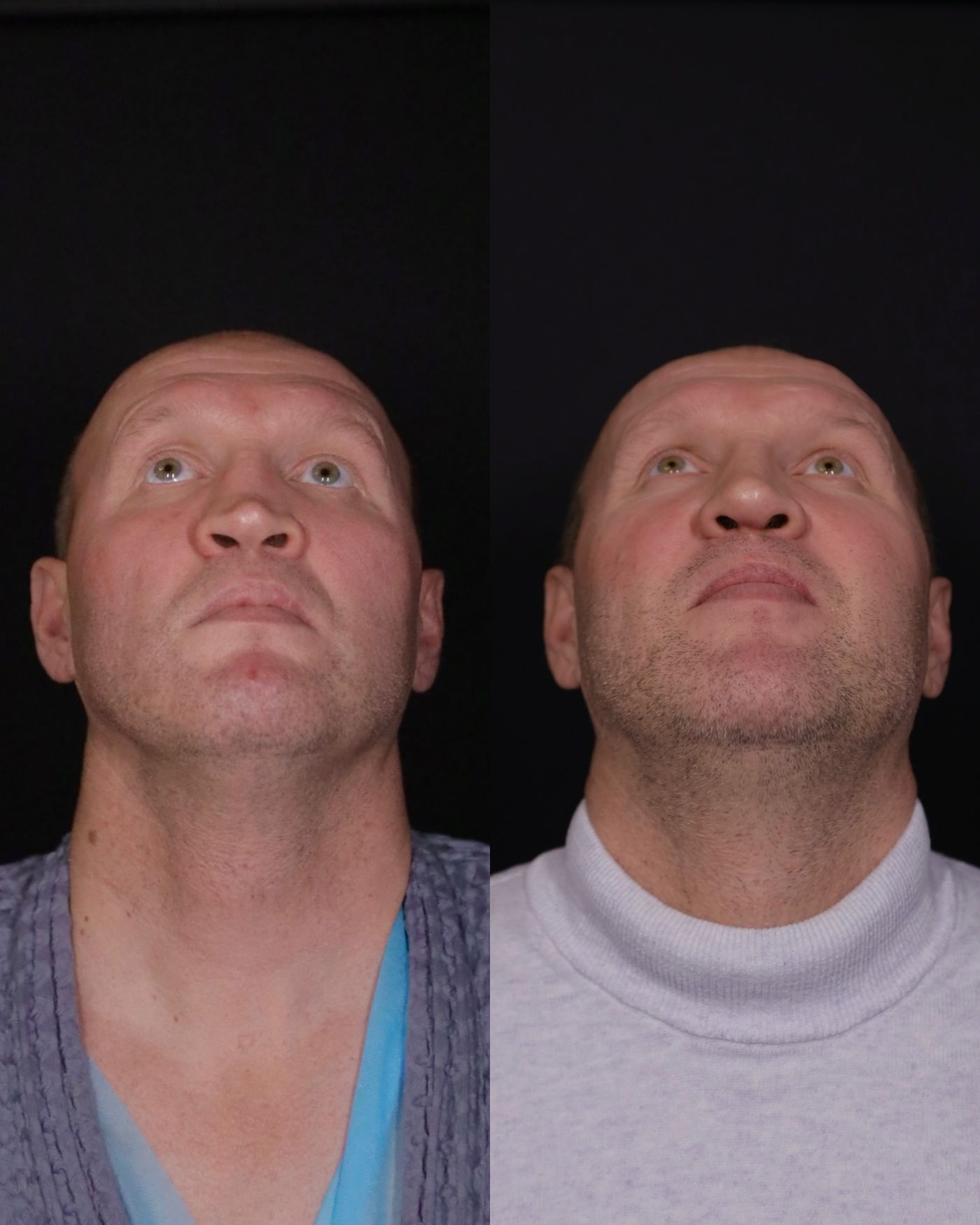 Revision rhinoplasty — before and after, photo 3