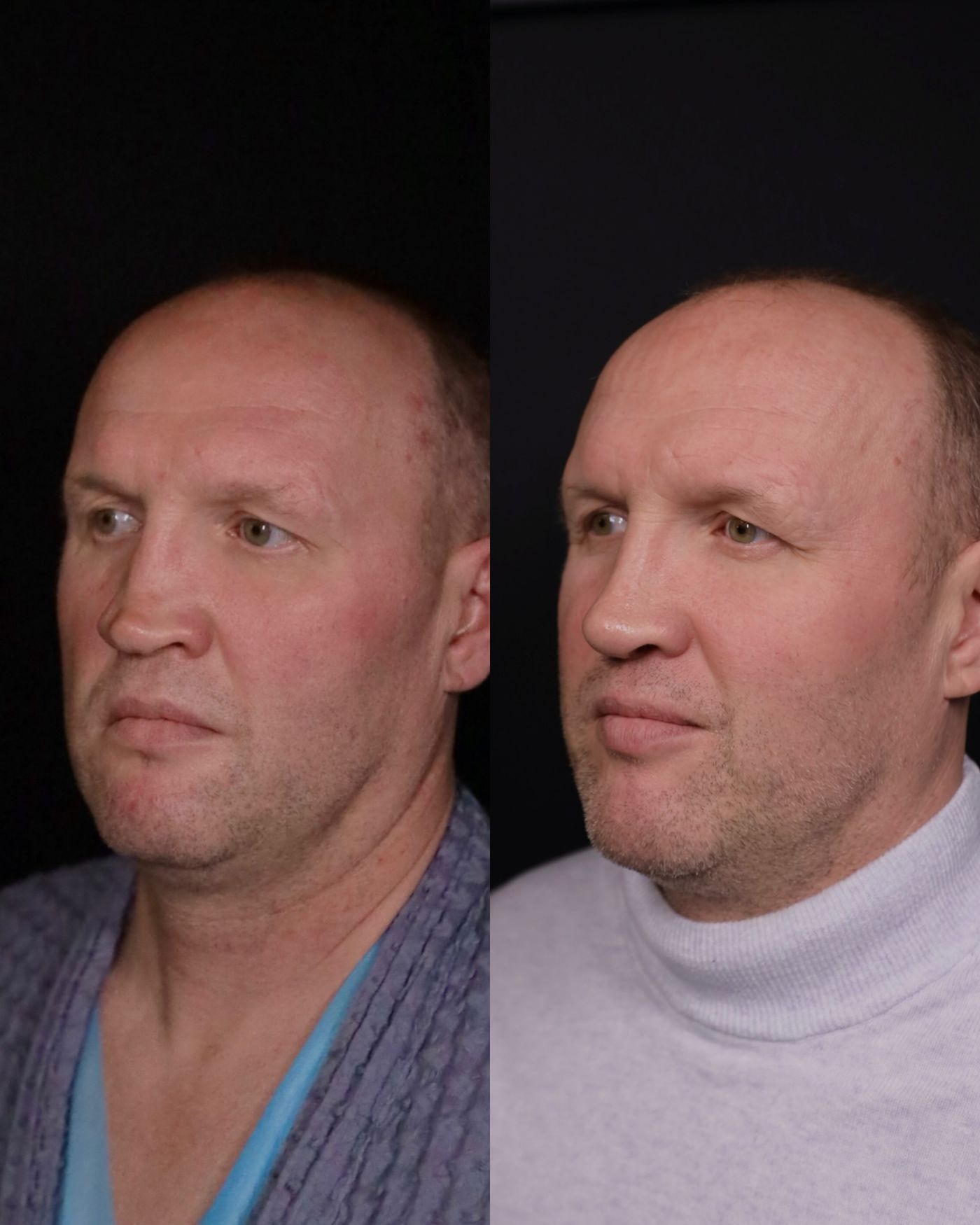 Revision rhinoplasty — before and after, photo 4