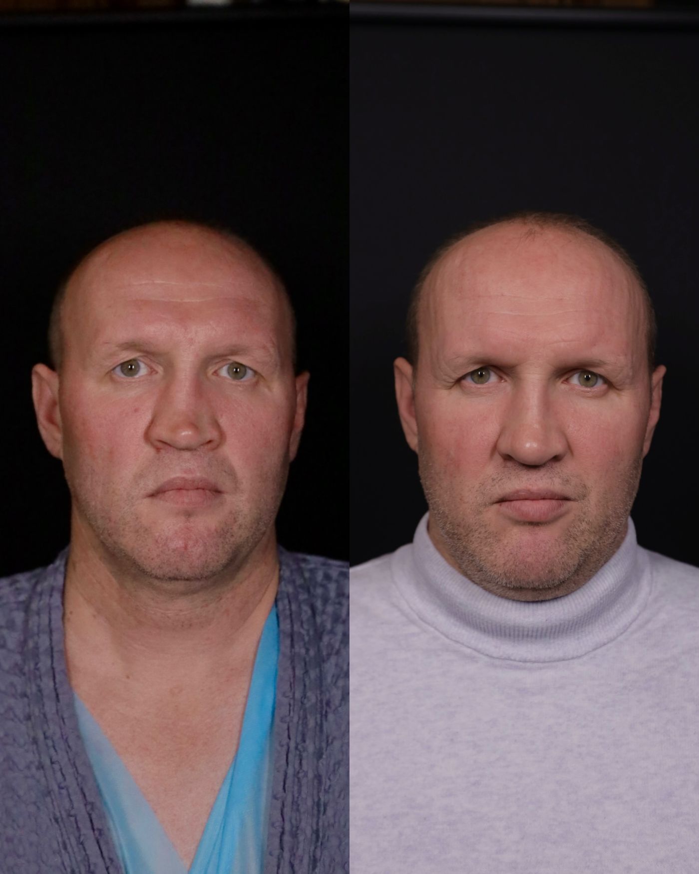 Revision rhinoplasty — before and after, photo 5