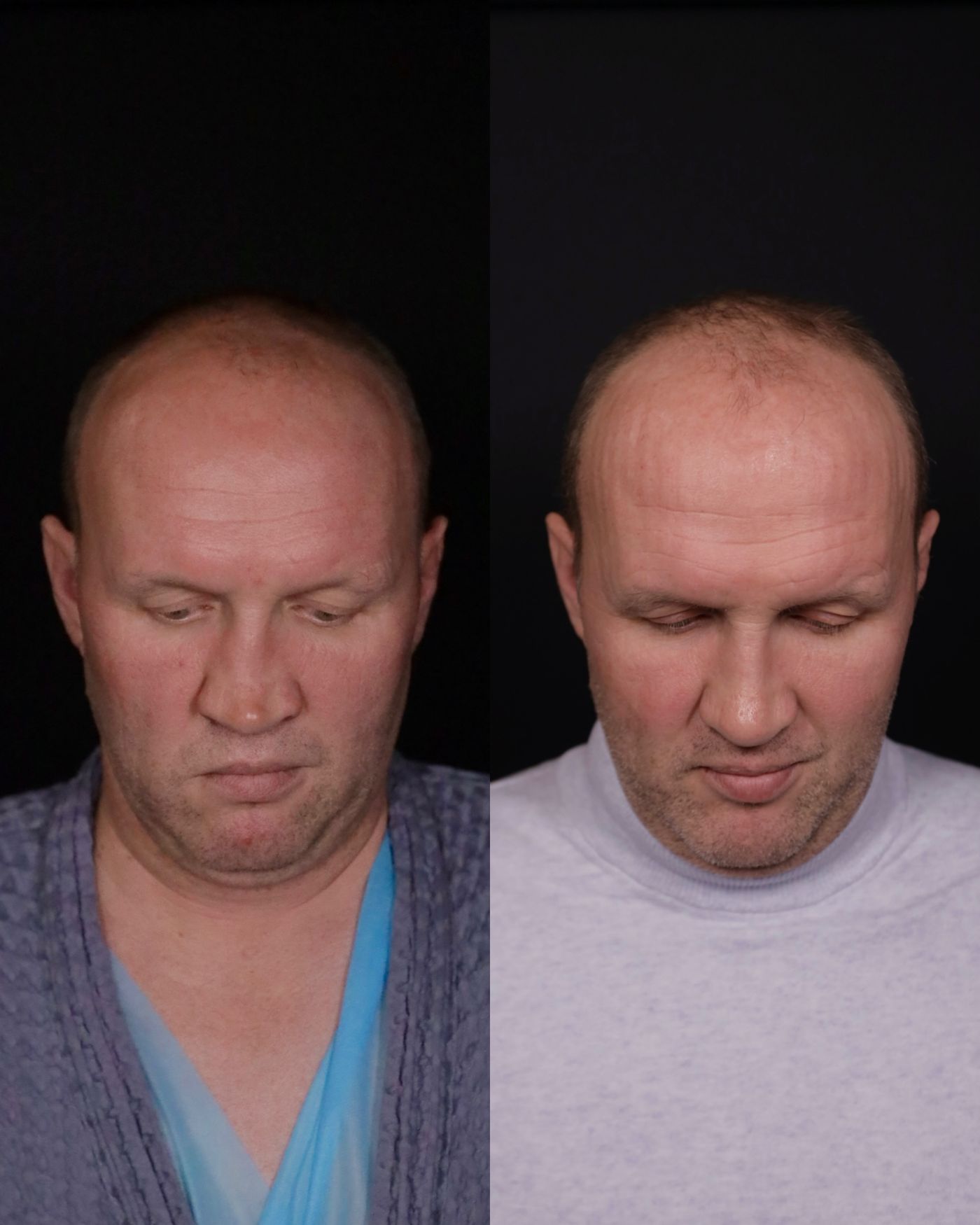 Revision rhinoplasty — before and after, photo 6
