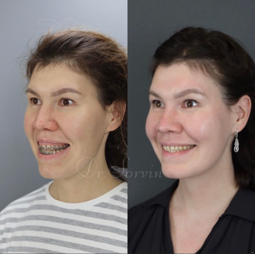 Anterior open bite — before and after, photo 1