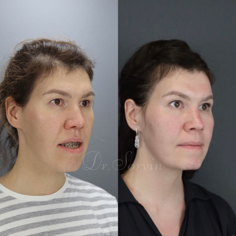 Anterior open bite — before and after, photo 2