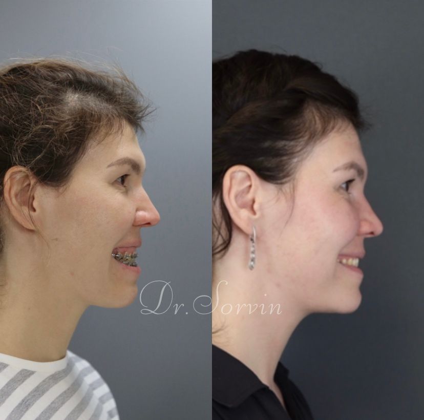 Anterior open bite — before and after, photo 3