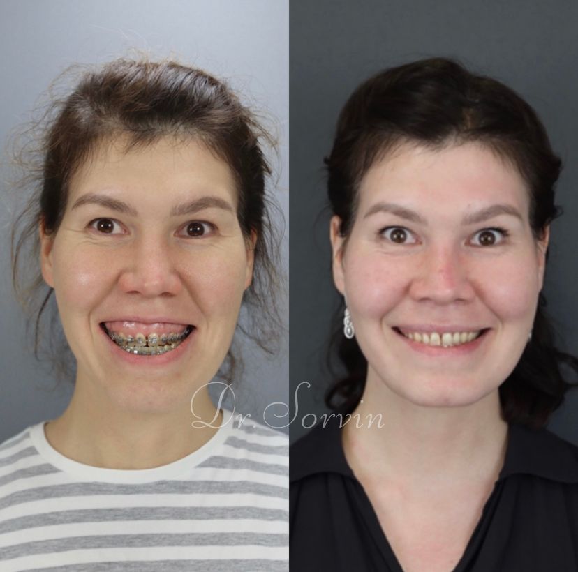 Anterior open bite — before and after, photo 4