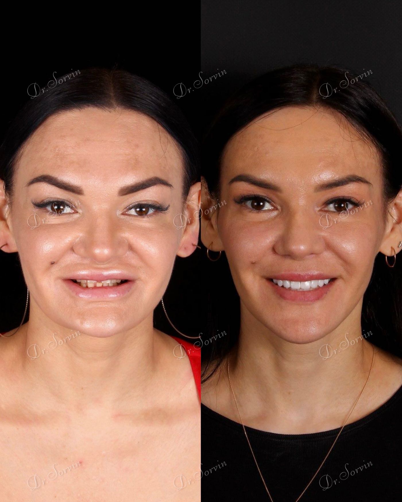Advancement of the lower facial third — before and after, photo 1