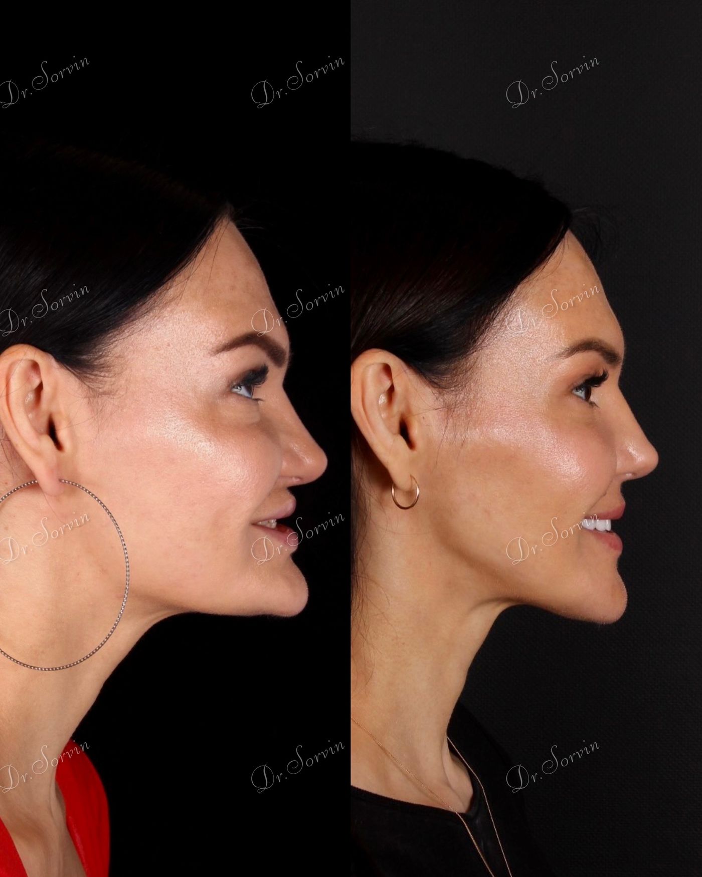 Advancement of the lower facial third — before and after, photo 2