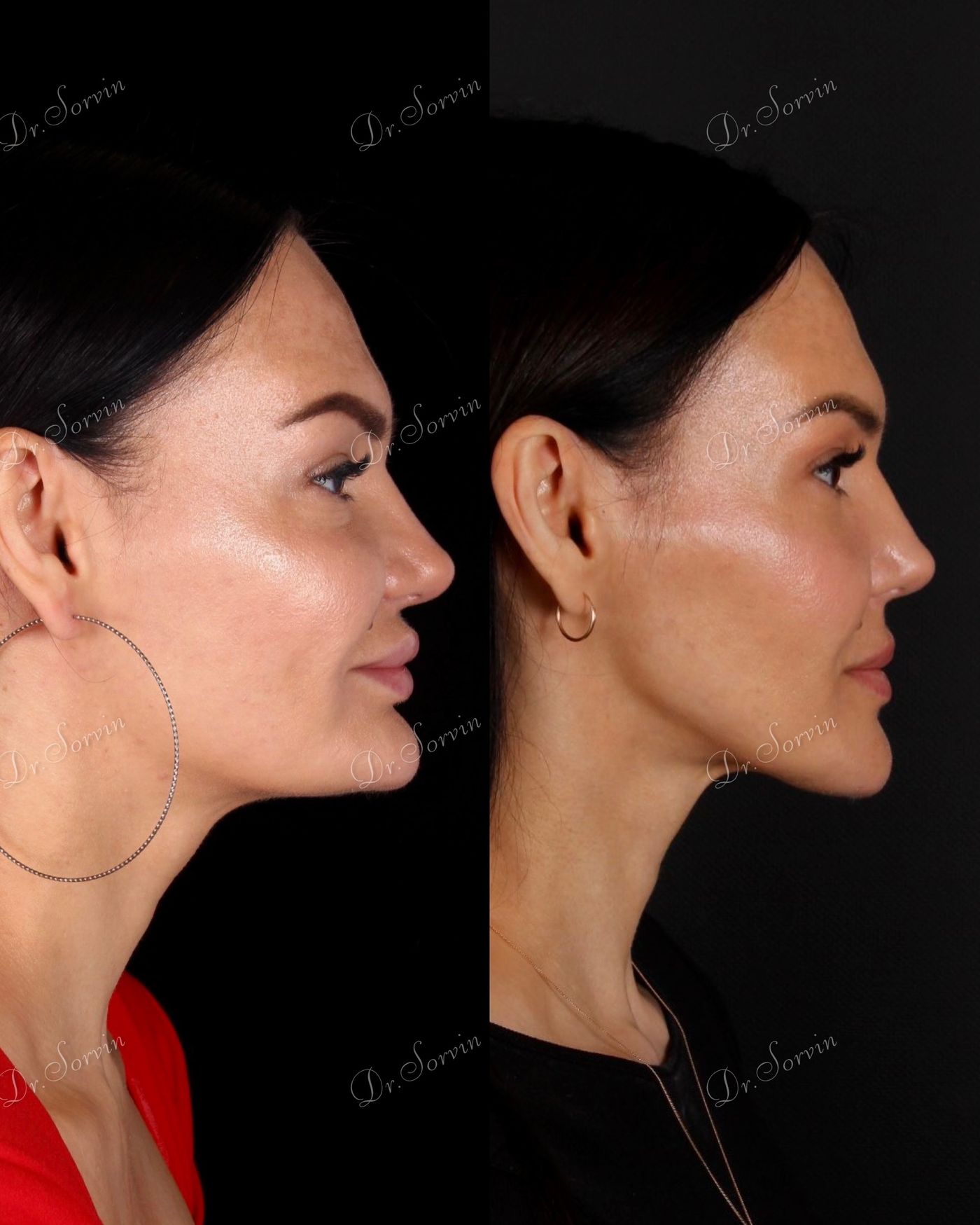 Advancement of the lower facial third — before and after, photo 3