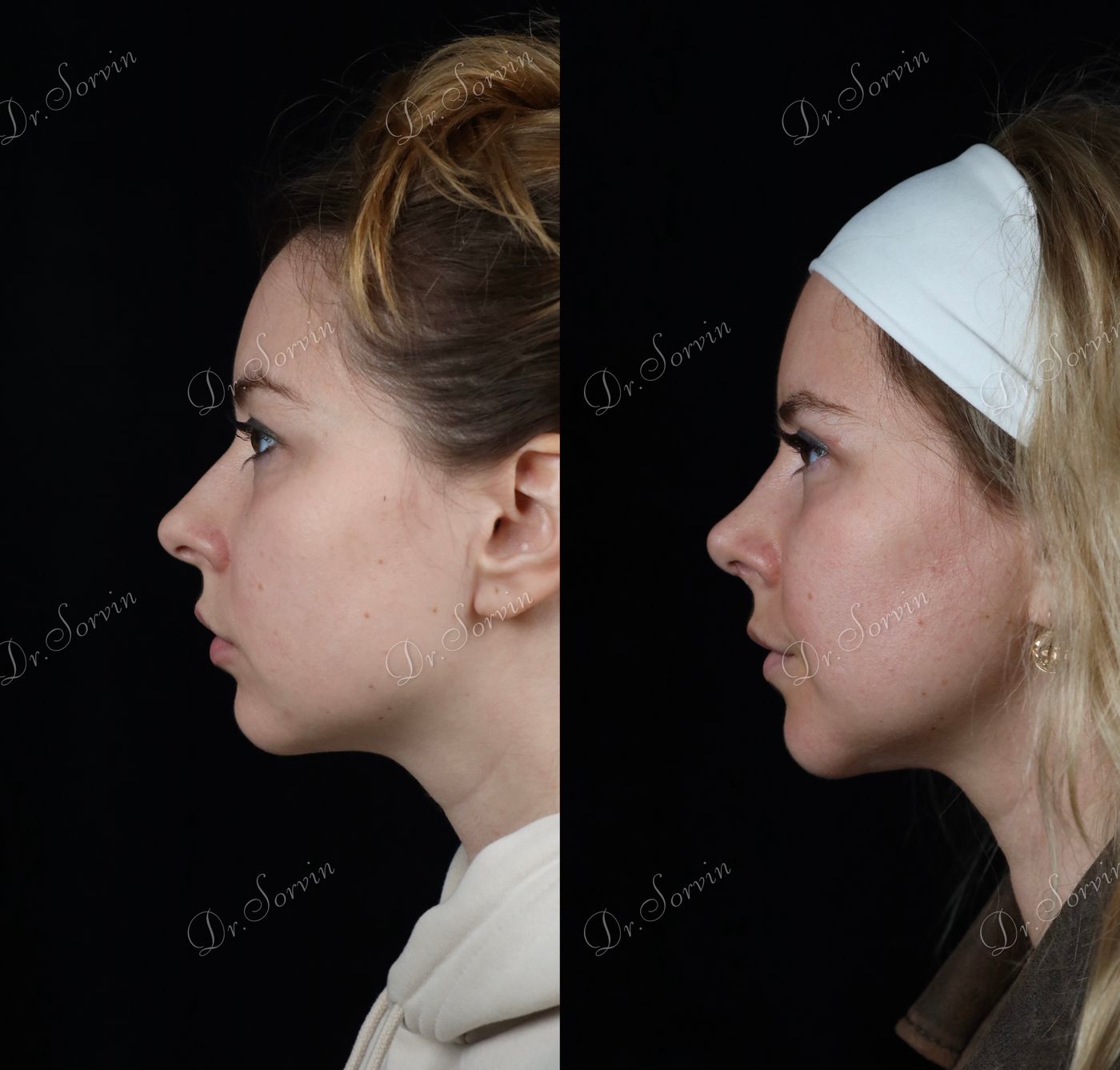 Rhinoplasty and genioplasty — 2 — before and after, photo 1