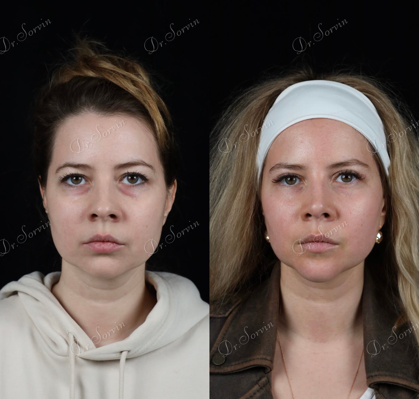 Rhinoplasty and genioplasty — 2 — before and after, photo 2