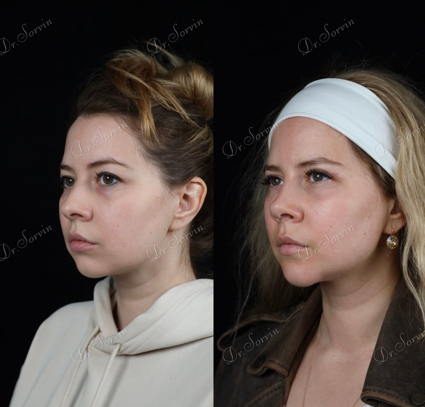 Rhinoplasty and genioplasty — 2 — before and after, photo 3