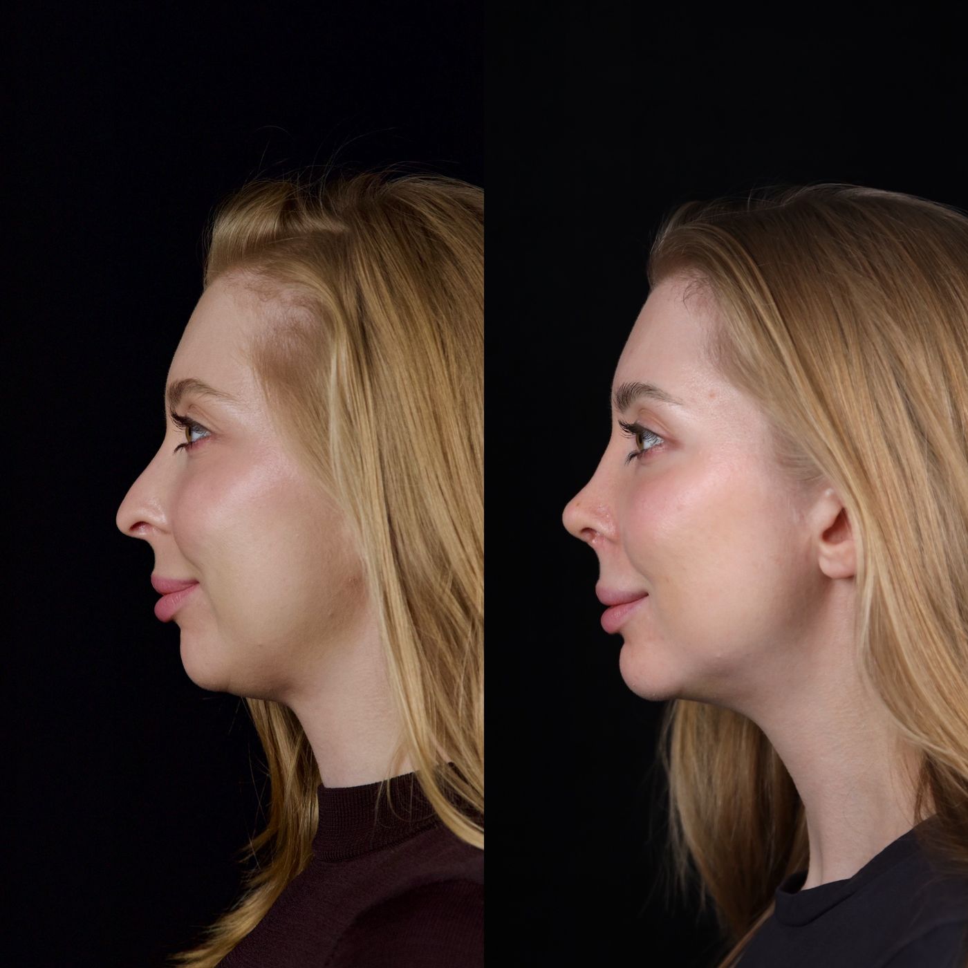 Rhinoplasty and genioplasty — before and after, photo 1