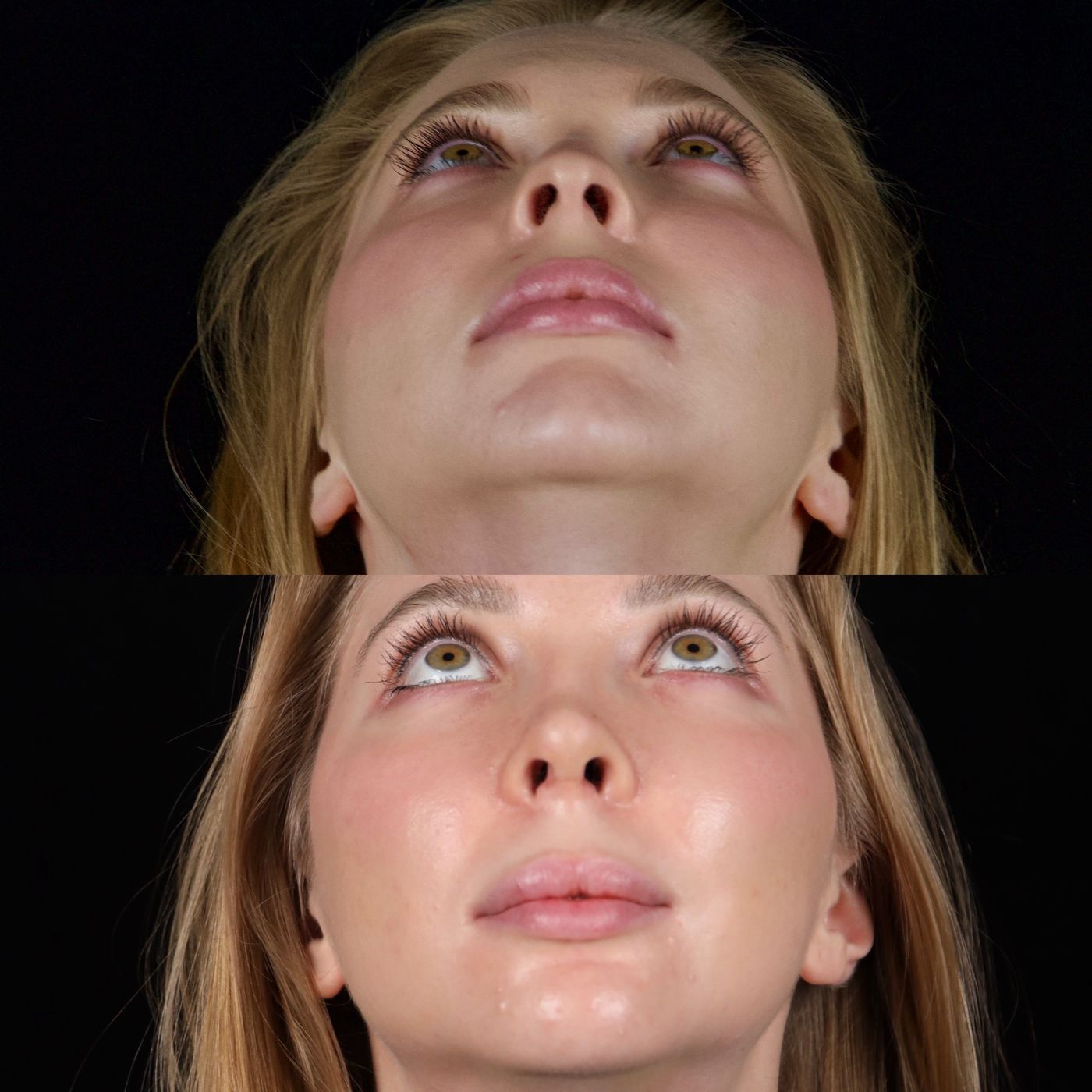 Rhinoplasty and genioplasty — before and after, photo 2