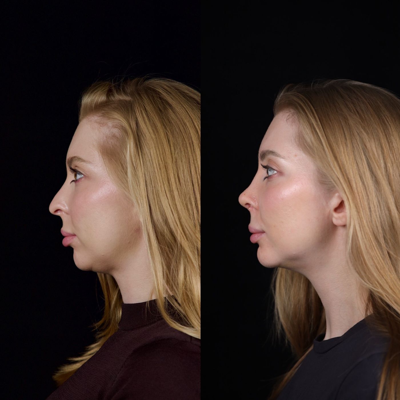 Rhinoplasty and genioplasty — before and after, photo 3