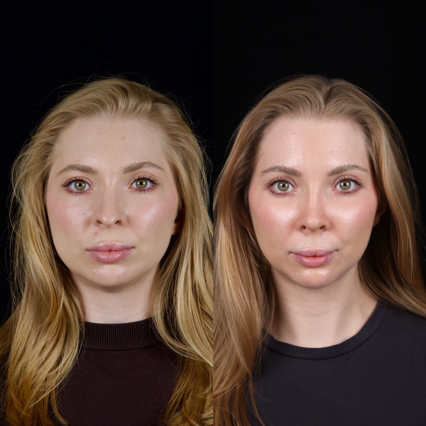 Rhinoplasty and genioplasty — before and after, photo 4